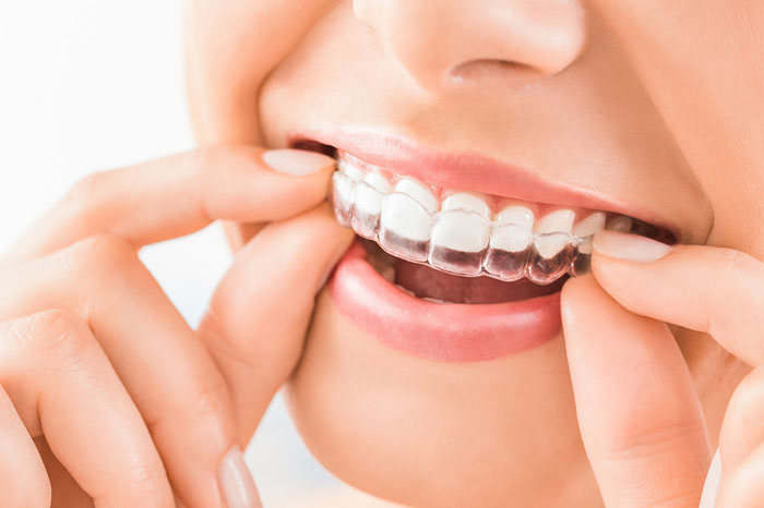 Boosting Your Teen’s Self-Esteem With Invisalign