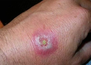 Insect bites Symptoms and its treatment.
