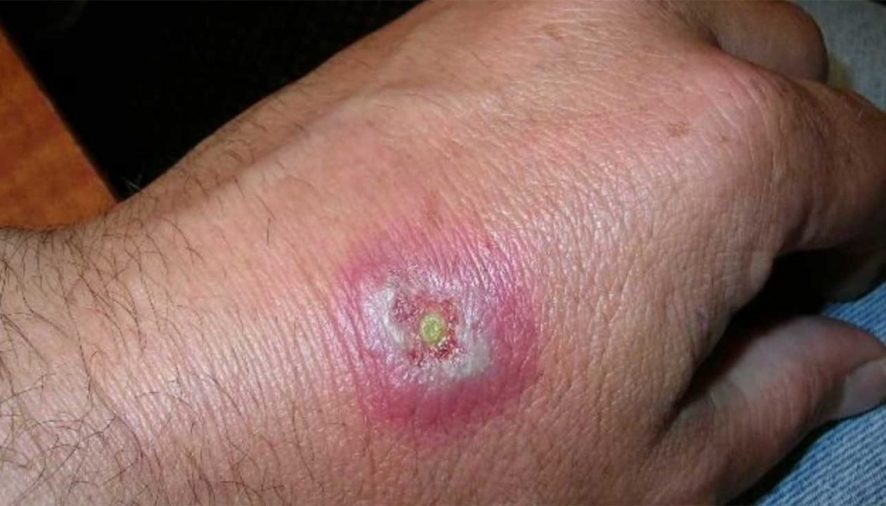 Insect bites Symptoms and its treatment.