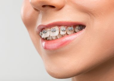A Comprehensive Look at Braces: Types and Options Available