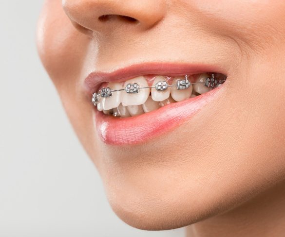 A Comprehensive Look at Braces: Types and Options Available