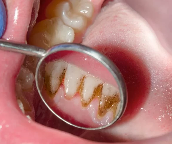 Gingivitis Explained: Maintaining Optimal Gum Health
