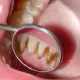 Gingivitis Explained: Maintaining Optimal Gum Health