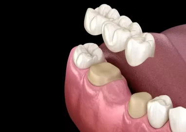 Understanding Common Problems of Dental Bridges