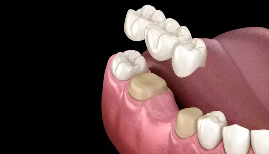 Understanding Common Problems of Dental Bridges